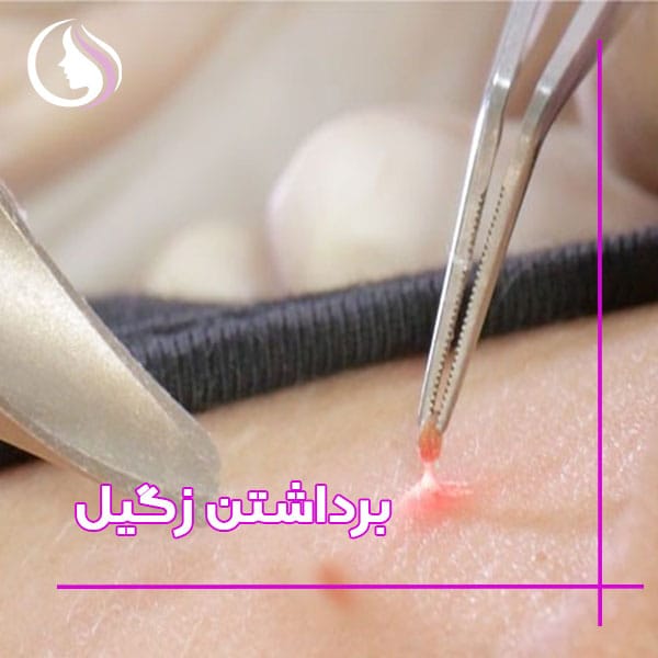 برداشتن زگیل