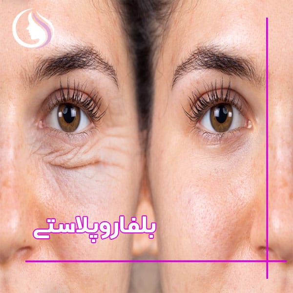 بلفاروپلاستی