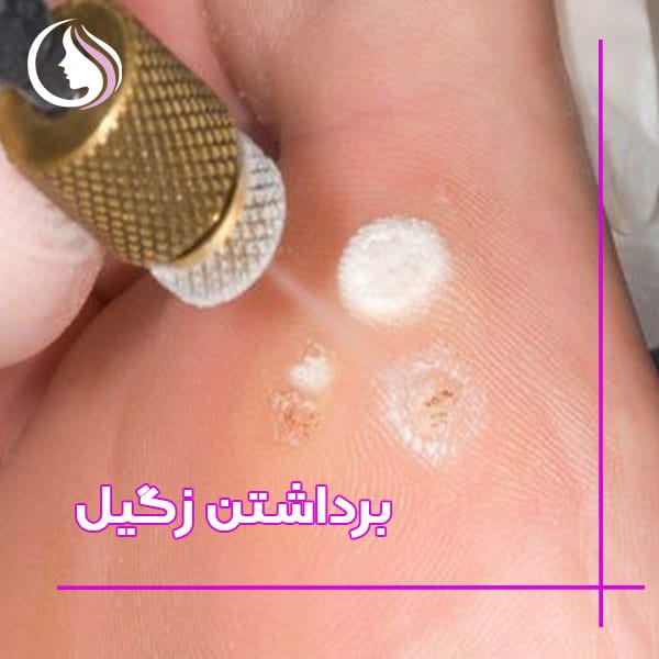 برداشتن زگیل