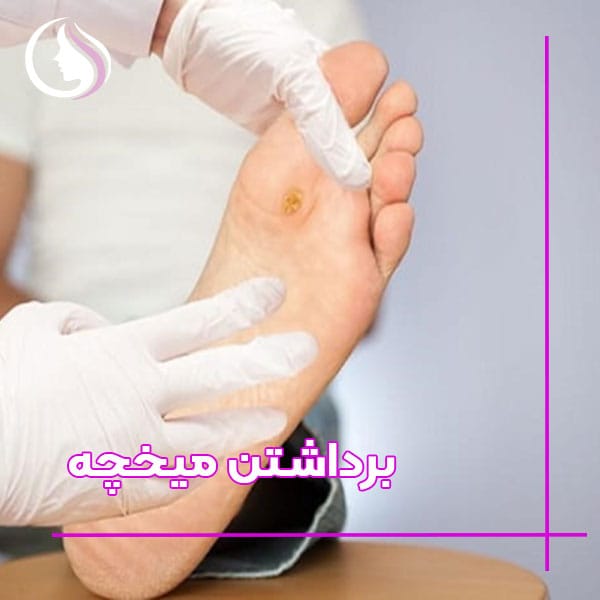 هزینه برداشتن میخچه