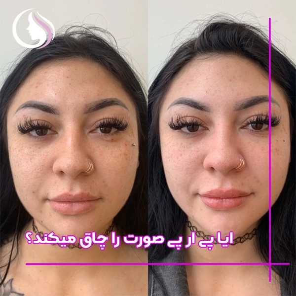 چاق کردن صورت با پی آر پی