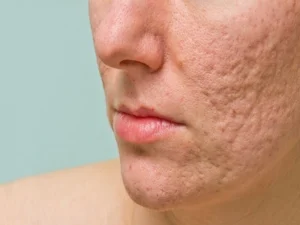 فرورفتگی جای زخم