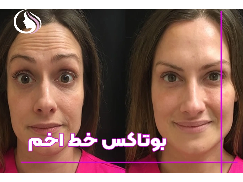 بوتاکس خط اخم 