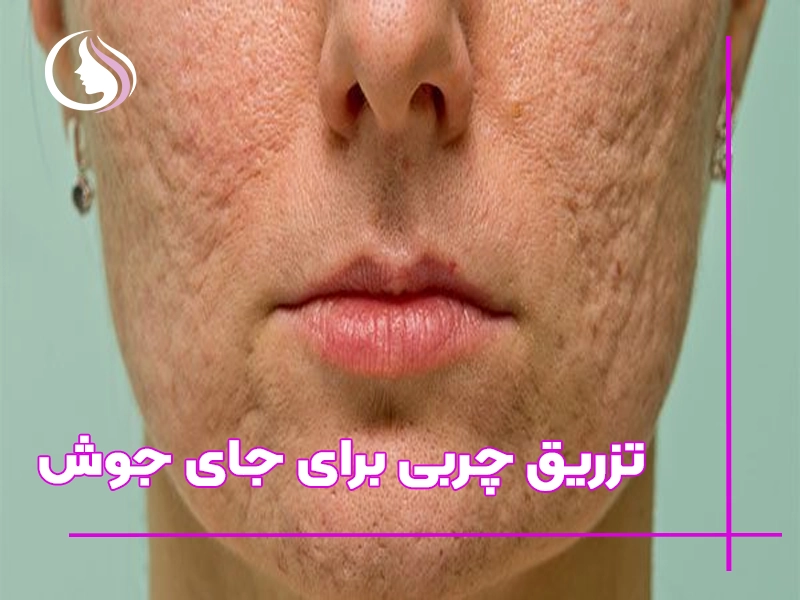 تزریق چربی برای جای جوش