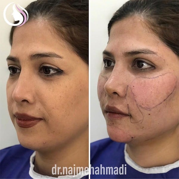 تزریق-چربی گونه